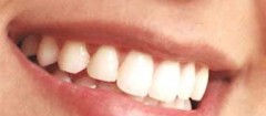 implantes-dentarios-sao-vicente-1488538547